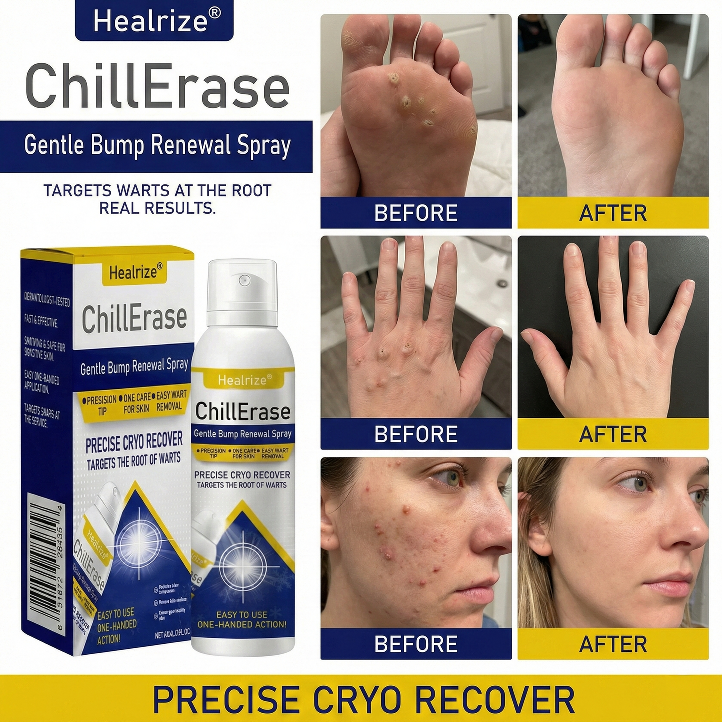 ❄️Healrize®ChillErase Gentle Bump Renewal Spray—✨Stubborn Skin Bumps & Rough Spots