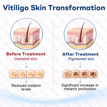 👨‍⚕️🔥Healrize® Piperine Vitiligo Repigmentation Spray - 🌿Steroid-Free Botanical Formula | Gentle & Effective for All Skin Types